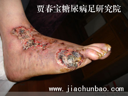 糖尿病民間奇方，怕失傳了 - 瀛子 - 瀛の小箋